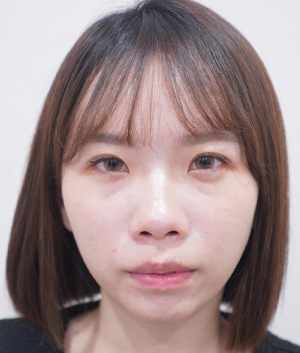隱痕眼袋手術前的照片Before